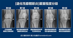 【退化性膝關節炎】的嚴重程度分級與對應的治療 | 關節炎,骨質疏鬆,骨科: 戴大為醫師