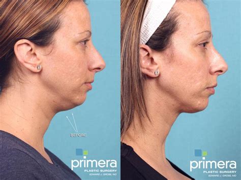 Kybella® Double Chin Treatment For Orlando And Winter Park Fl Primera