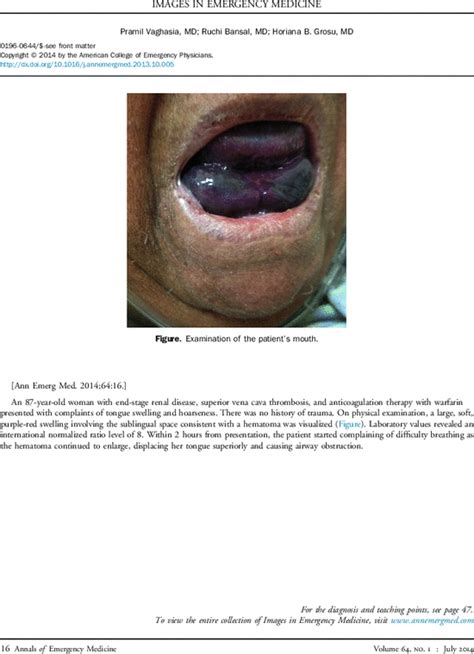Elderly Woman With Tongue Swelling Annals Of Emergency Medicine