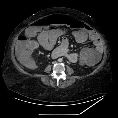 Obstructive Colonic Diverticular Stricture Image