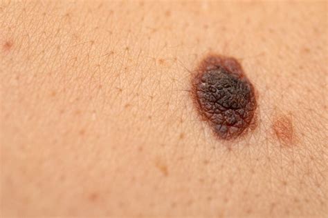 Skin Cancer Diagnosis Apps Are Unreliable And Poorly Regulated Study