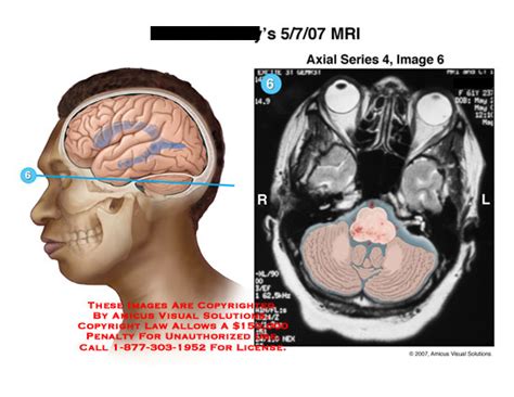 AMICUS Illustration Of Amicus Injury Brainstem Cerebellum Brain Mri
