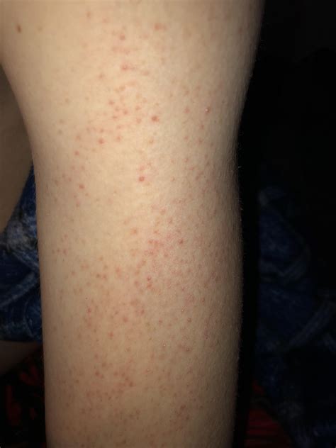 Skin Concerns Red Bumps All Over Upper Arms And I Dont Know How To