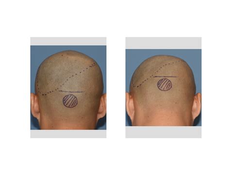 Plastic Surgery Case Study Custom Occipital Implant With Occipital