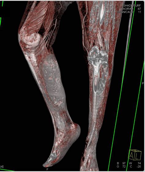 Hematoma In The Calf Musculoskeletal Case Studies Ctisus Ct Scanning