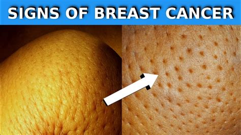 15 Warning Signs Of Breast Cancer You Shouldnt Ignore Youtube