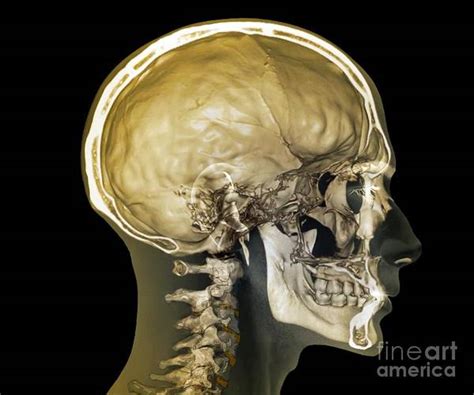 Normal Head And Neck 3d Ct Scan Art Print By Zephyr Pixels