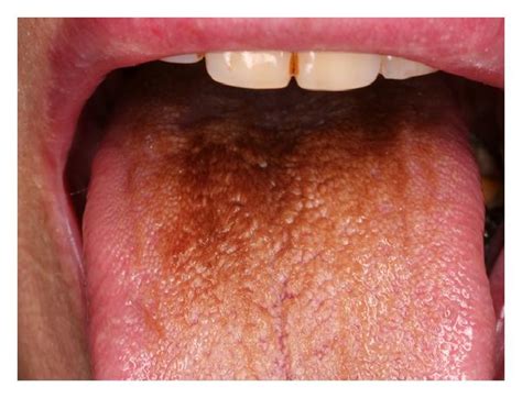 Dermoscopic Features Of A Black Hairy Tongue In 2 Japanese Patients