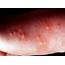 Papular Urticaria  Pictures Causes Treatment Symptoms
