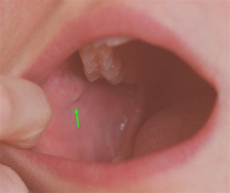 Salivary Gland Terminology Anatomy Salivation Dry Mouth Drooling