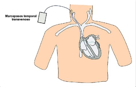 Marcapasos Temporal Transvenoso Download Scientific Diagram