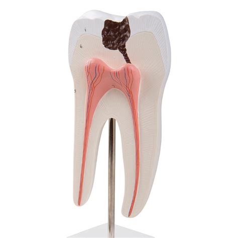 Anatomical Model Lower Twin Root Molar Showing Cavities 2 Part