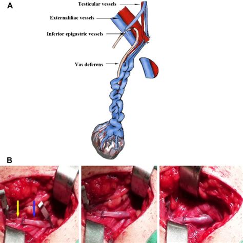 Surgical Management Of Nutcracker Phenomenon Presenting As Left