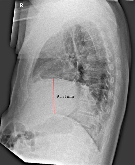 Cureus Elevated Right Hemidiaphragm A Clue In Acute Cholecystitis