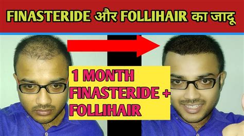 Finasteride Before And After Finasteride Follihair Youtube