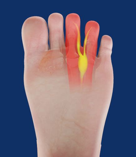 Mortons Neuroma Springfield Mortons Neuroma Treatment Chicopee Ma