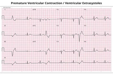 Premature Ventricular Contractions Pvcs Causes Symptoms And