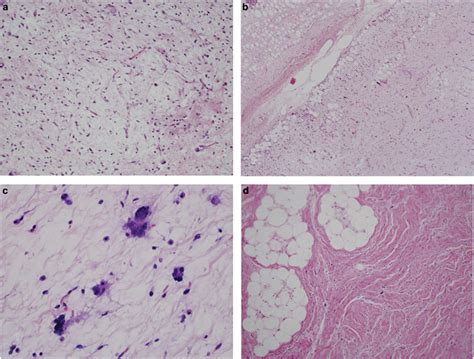 Well Differentiated Liposarcoma With Prominent Myxoid Areas Is
