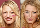 Blake Lively (Before and after) Blake Lively Plastic Surgery, Celebrity ...