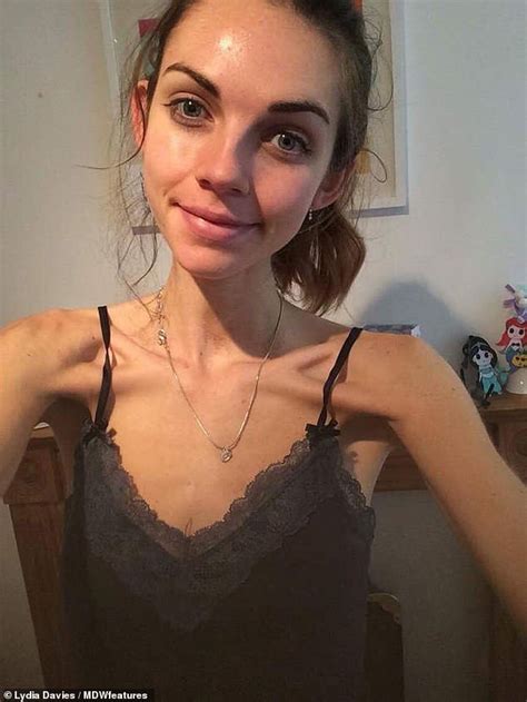 Former Anorexic Whose Weight Plummeted To Six Stone Turns Life Around Big World News