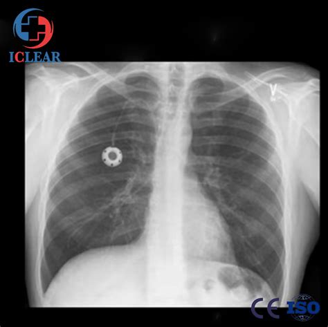 Tivad Subsutaneous Implantable Central Venous Access Chest Port China