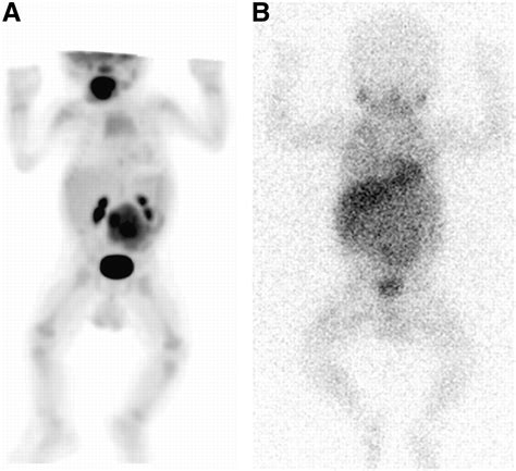 123i Mibg Scintigraphy And 18f Fdg Pet In Neuroblastoma