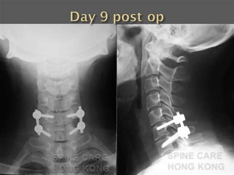 Lower Cervical Spine Fractures And Dislocations Unilateral Facet