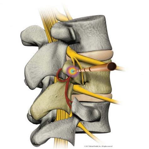 Lumbar Cooled Radiofrequency Pain Spa