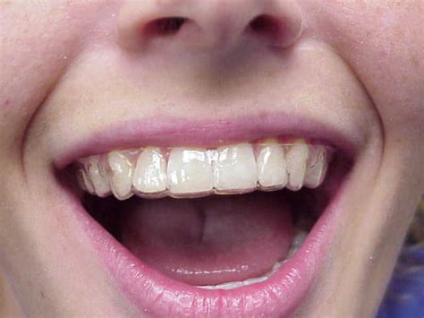 Maybe you would like to learn more about one of these? Gallery Invisible Retainers