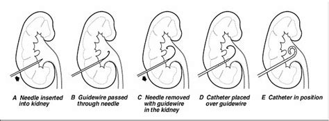 Percutaneous Nephrostomy Drainage Health And Nutrition Facts For You