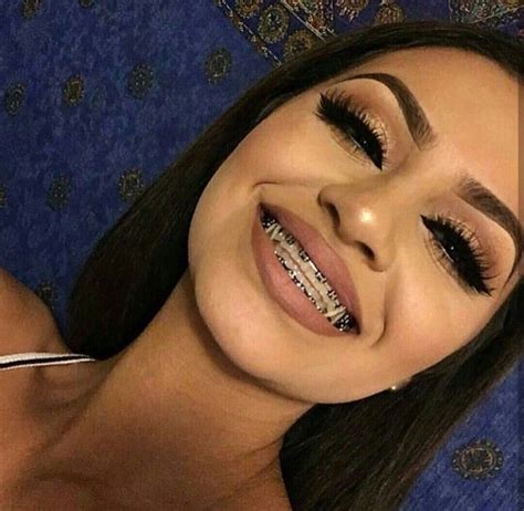 Best Braces Colors For Girls Gif