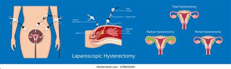 Laparoscopic Hysterectomy Medical Surgical Treat Cervix Stock Vector