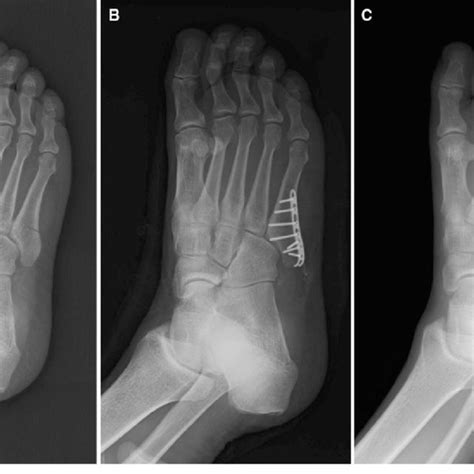 A 48 Year Old Man With A Fifth Metatarsal Base Fracture A Preoperative