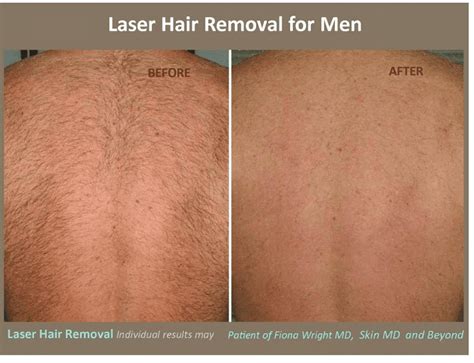Maybe you would like to learn more about one of these? Laser Hair Removal Plano TX | Hair Removal Frisco TX ...