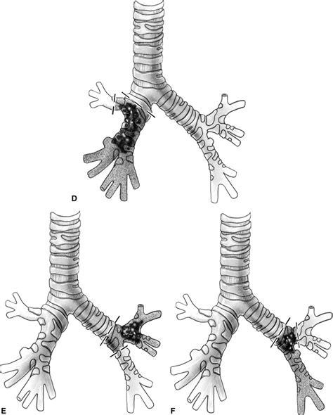 Parenchymal Sparing Procedures In Lung Cancer Sleeve Resection Of The