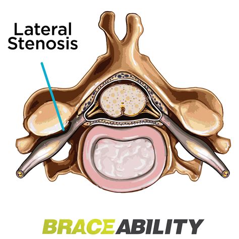 The Difference Between Foraminal Central Lateral Recess Stenosis In