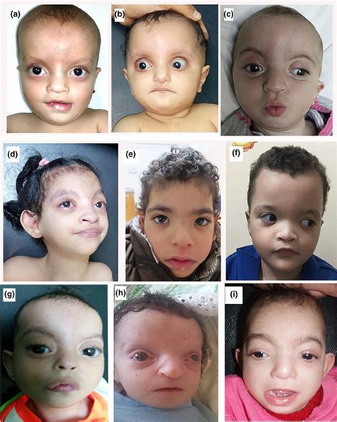 Clinical And Genetic Characterization Of Ten Egyptian Patients With Wolfhirschhorn Syndrome And