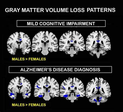 Alzheimers Differing Effects On Male Female Brains Diagnostic Imaging