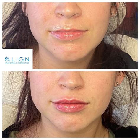 Pin By Align Injectable Aesthetics On Before And After Lip Fillers Versa Lips