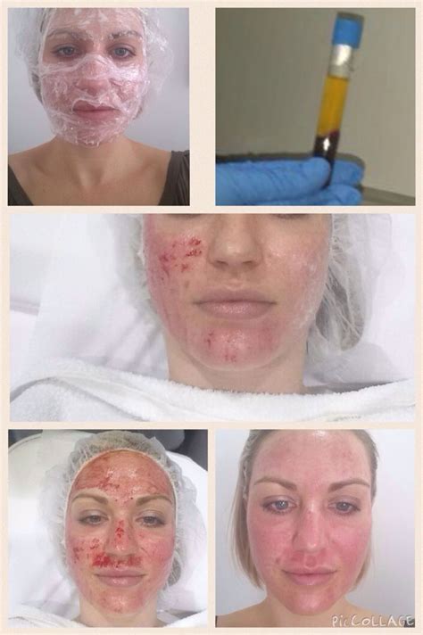 Prp Vampire Facial Can Help To Improve The Condition Of Your Skin By