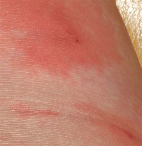 Bacterial Infection On Skin Treatment