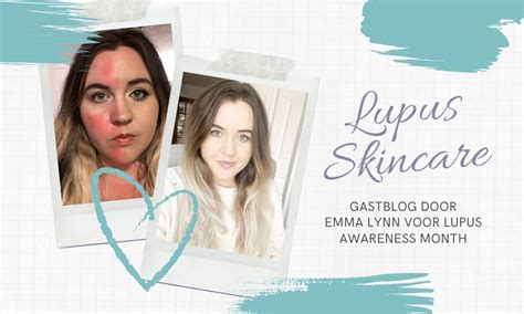 Lupus Skincare Tips Door Emma Lynn Lupus Awareness Month Rosalique