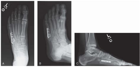 Open Reduction And Internal Fixation Of Proximal Fifth Metatarsal Fractures Musculoskeletal Key