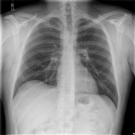 Right Sided Aortic Arch Image