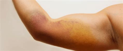 Do You Bruise Easily Here Are 7 Possible Reasons Why Whats Good By V