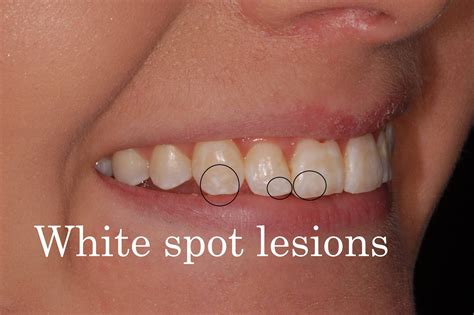 White Spots Teeth What Are They And How Do You Get Rid Of Them