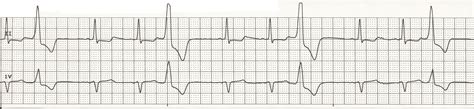 Float Nurse Ekg Rhythm Strips 19 Ventricular Ectopy 2