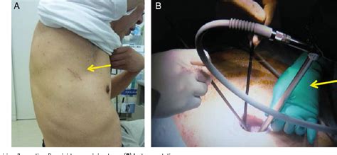 Figure 1 From Single Incision Thoracoscopic Surgery And Conventional