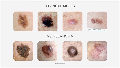 Atypical Moles Guide Definitions Pictures And Risks