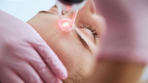 Tratamento a Laser para Manchas Clínica de Dermatologia em São Paulo